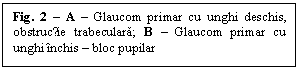 Text Box: Fig. 2 - A - Glaucom primar cu unghi deschis, obstrucție trabeculara; B - Glaucom primar cu unghi inchis - bloc pupilar