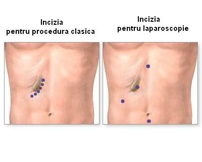 Colecistectomie: incizii (clasic si laparoscopic)