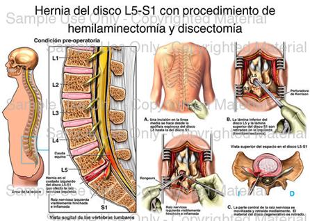 Loading: 'Hernia del disco L5-S1 con procedimiento de hemilaminectoma y discectoma' - Please wait