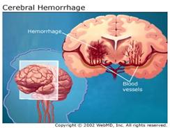 Cerebral Hemorrhage