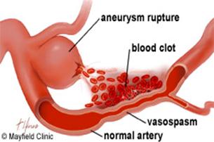 vasospasm