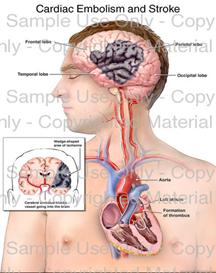 Loading: 'Cardiac Embolism and Stroke' - Please wait