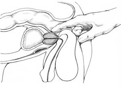 Cross-section diagram of digital rectal exam showing patient's lower urinary tract and rectum. The doctor's index finger is inserted into the patient's rectum to feel the size and shape of the prostate.