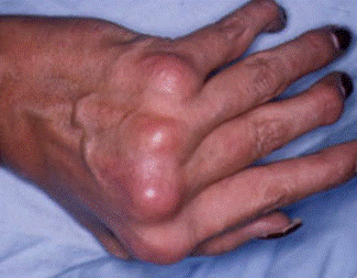 Artrita psoriazica deformari degete