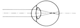 Sa intelegem viciile de refractie - Optica OptiKlar