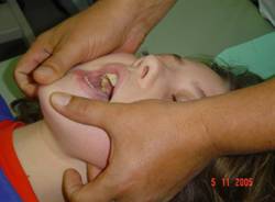 subluxatia mandibulei