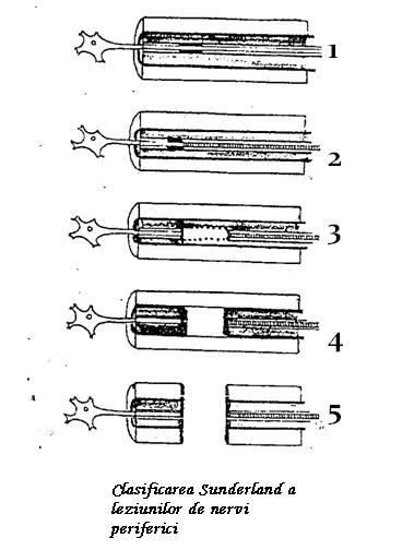 C:Documents and SettingsJustin CaseDesktopLucrare DiplomaPatologie pozeClasif Sunderland.JPG