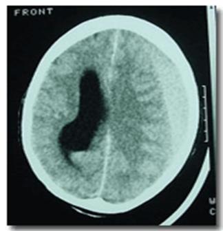 Hematom subdural acut