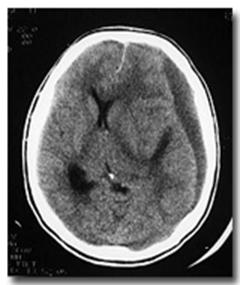 Hematom subdural cronic