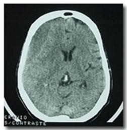 Hematom subdural cronic