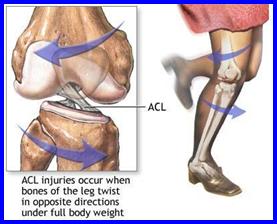 Ligament incrucisat anterior - leziuni 2